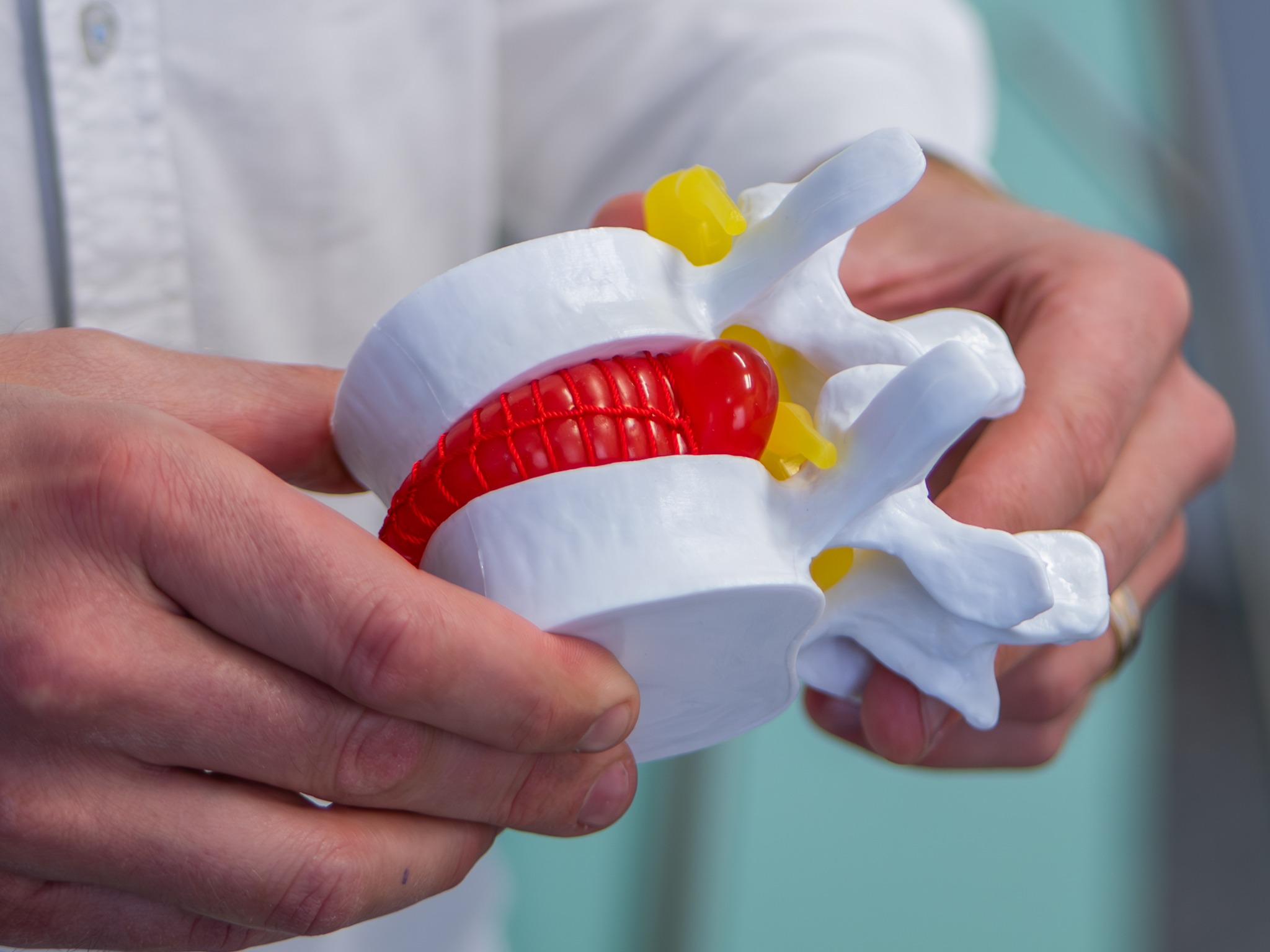 Model hernije diska – prikaz